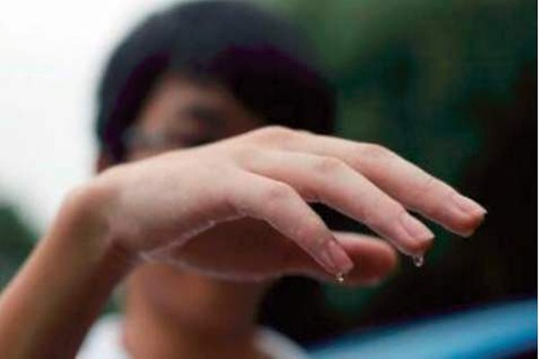 多汗癥是什么 多汗癥出汗程度怎么分級的 多汗癥是什么 多汗癥出汗程度怎么分級的