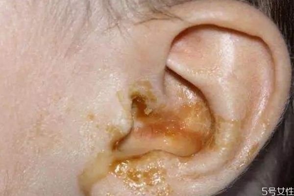 什么是耳中炎呢 耳中炎有什么癥狀呢 什么是耳中炎呢 耳中炎有什么癥狀呢