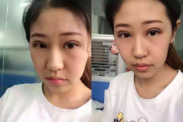 5s重瞼術有失敗的嗎 5s重瞼術的優(yōu)點有哪些