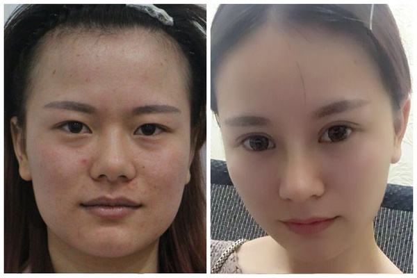 5s重瞼術有失敗的嗎 5s重瞼術的優(yōu)點有哪些