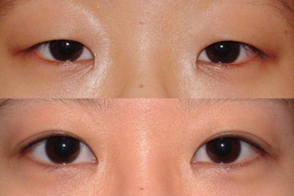 重瞼修復(fù)術(shù)是什么 重瞼修復(fù)術(shù)術(shù)前要準(zhǔn)備什么