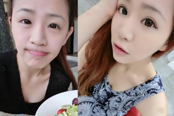 上瞼松弛變美術(shù)是什么 上瞼松弛變美術(shù)術(shù)前要注意什么 上瞼松弛變美術(shù)是什么 上瞼松弛變美術(shù)術(shù)前要注意什么