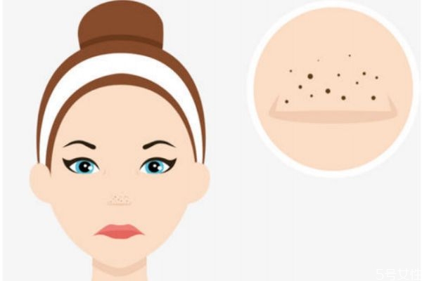 如何去黑頭呢 去黑頭的辦法有什么呢 如何去黑頭呢 去黑頭的辦法有什么呢