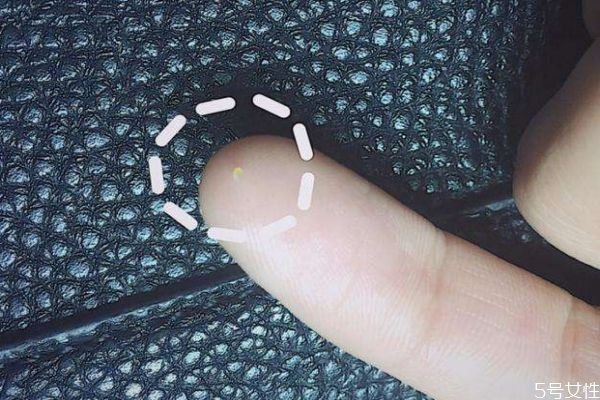 如何預(yù)防脂肪粒呢 預(yù)防脂肪粒的辦法有什么呢 如何預(yù)防脂肪粒呢 預(yù)防脂肪粒的辦法有什么呢