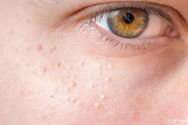 脂肪粒是不是閉口 脂肪粒是不是營(yíng)養(yǎng)過剩