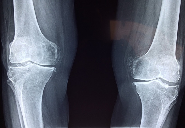 氨糖是什么 健力多氨糖了解一下 氨糖是什么 健力多氨糖了解一下