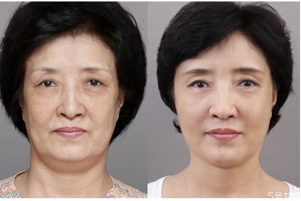 皮膚松弛的原因有什么呢 為什么會(huì)皮膚松弛呢 皮膚松弛的原因有什么呢 為什么會(huì)皮膚松弛呢