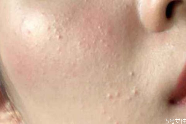 額頭長閉口怎么去除 額頭長閉口的原因 額頭長閉口怎么去除 額頭長閉口的原因
