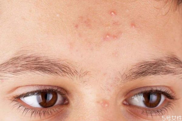 額頭長閉口怎么去除 額頭長閉口的原因 額頭長閉口怎么去除 額頭長閉口的原因