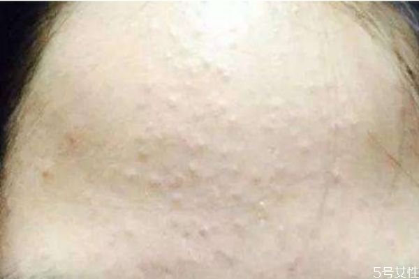 額頭長閉口怎么去除 額頭長閉口的原因 額頭長閉口怎么去除 額頭長閉口的原因