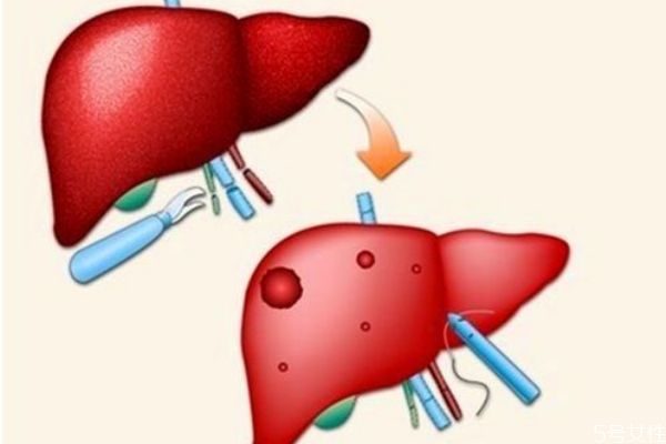 什么是肝囊腫呢 肝囊腫有什么危害呢 什么是肝囊腫呢 肝囊腫有什么危害呢