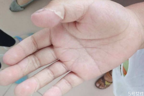 什么是猩紅熱呢 猩紅熱有什么癥狀呢 什么是猩紅熱呢 猩紅熱有什么癥狀呢