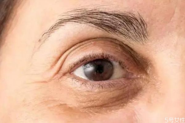 去除眼袋的方法有什么呢 如何可以快速去眼袋呢 去除眼袋的方法有什么呢 如何可以快速去眼袋呢
