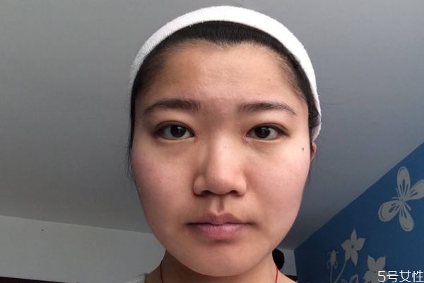 鼻翼太大的原因是什么呢 造成鼻翼太大的原因是什么呢 鼻翼太大的原因是什么呢 造成鼻翼太大的原因是什么呢