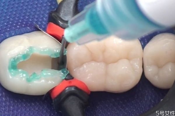 牙縫變大是怎么造成的呢 牙縫變大有什么危害呢 牙縫變大是怎么造成的呢 牙縫變大有什么危害呢