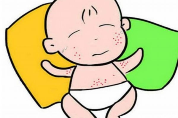 什么是痱子呢 痱子有什么癥狀呢 什么是痱子呢 痱子有什么癥狀呢