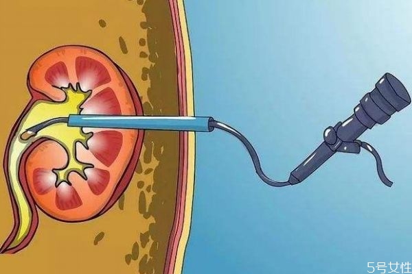 腎積水的高發(fā)人群有哪些呢 造成腎積水的原因有什么呢 腎積水的高發(fā)人群有哪些呢 造成腎積水的原因有什么呢