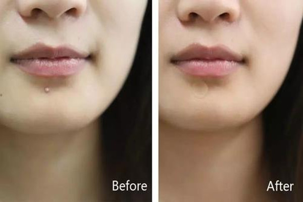 隱形痘痘貼是什么 隱形痘痘貼有用嗎 隱形痘痘貼是什么 隱形痘痘貼有用嗎