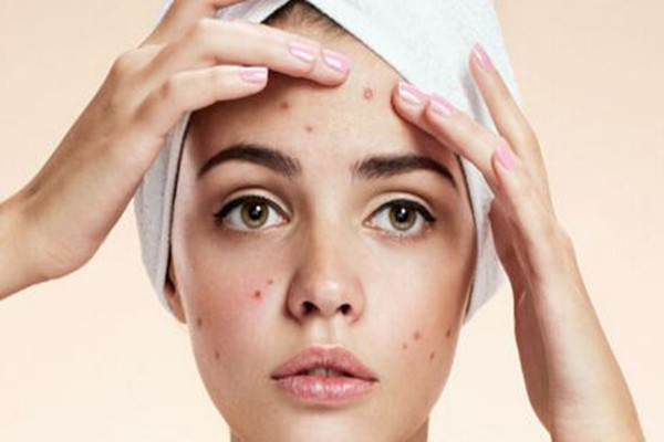 痘印消失的時間跟膚色有關(guān)嗎 痘印要多久能消除 痘印消失的時間跟膚色有關(guān)嗎 痘印要多久能消除