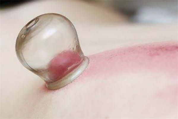 拔罐減肥什么時(shí)間最好 拔罐減肥什么季節(jié)最好 拔罐減肥什么時(shí)間最好 拔罐減肥什么季節(jié)最好