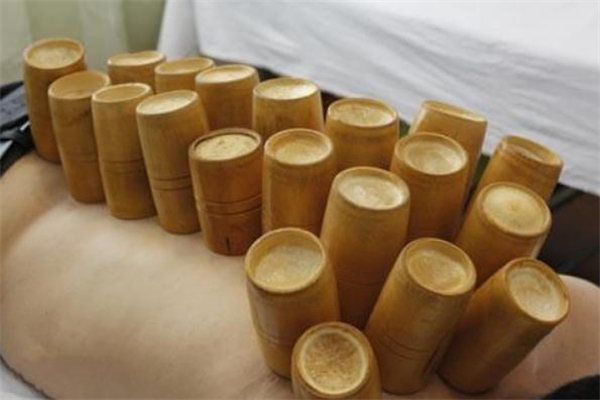 拔罐減肥是天天拔嗎 拔罐減肥多久拔一次 拔罐減肥是天天拔嗎 拔罐減肥多久拔一次