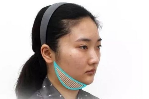 雙下巴溶脂后幾天看見效果 雙下巴溶脂效果是永久的嗎 雙下巴溶脂后幾天看見效果 雙下巴溶脂效果是永久的嗎