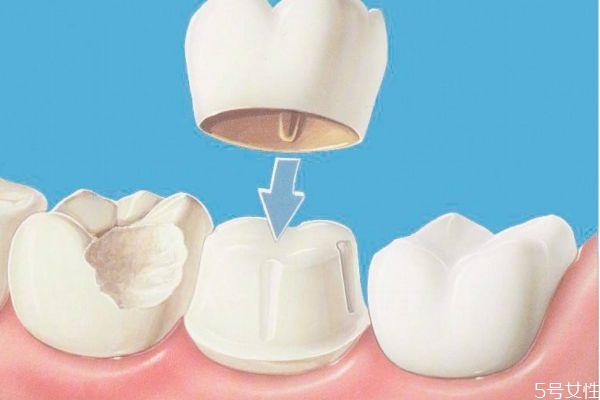 美容冠矯正有什么作用 美容冠矯正多少錢(qián)