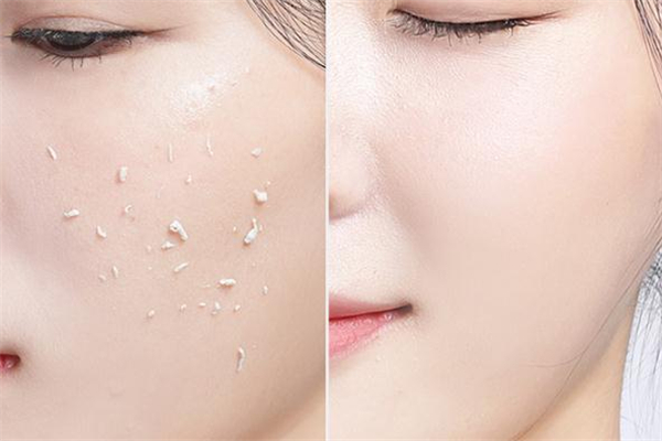 美康粉黛去角質(zhì)啫喱怎么使用-可以去雞皮嗎 美康粉黛去角質(zhì)啫喱怎么使用-可以去雞皮嗎