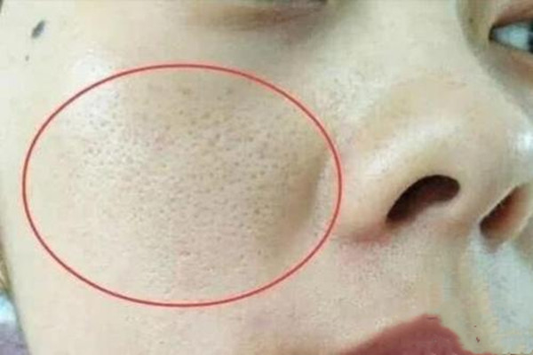 毛孔堵塞的癥狀 如何預防毛孔堵塞 毛孔堵塞的癥狀 如何預防毛孔堵塞
