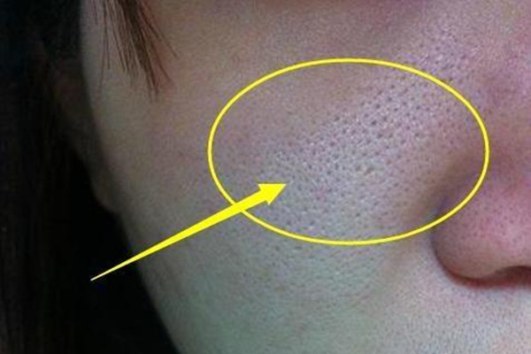 毛孔堵塞的癥狀 如何預防毛孔堵塞 毛孔堵塞的癥狀 如何預防毛孔堵塞