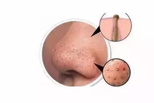 毛孔堵塞的癥狀 如何預防毛孔堵塞 毛孔堵塞的癥狀 如何預防毛孔堵塞