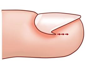 如何預防嵌甲呢 嵌甲能根治嗎