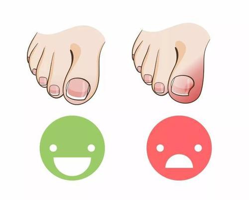 如何預防嵌甲呢 嵌甲能根治嗎