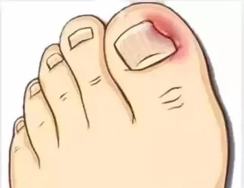 如何預防嵌甲呢 嵌甲能根治嗎