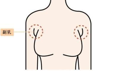 什么是副乳 怎么判斷自己有沒(méi)有副乳