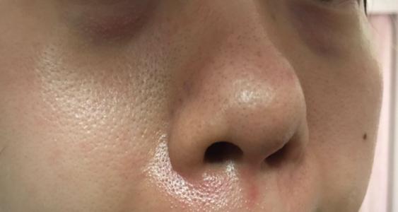 鼻子起皮怎么辦 鼻子起皮用什么水洗臉