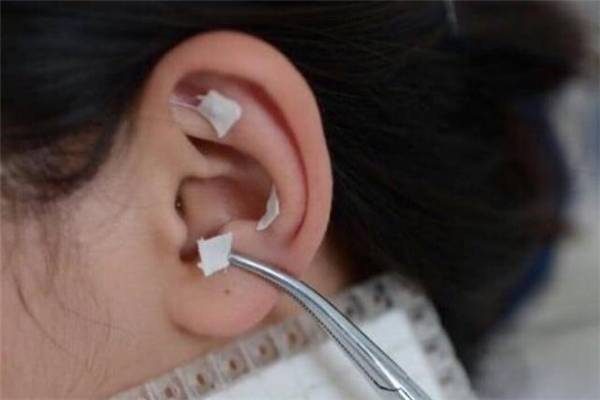 耳針貼可以減肥嗎 耳針貼適合什么人 耳針貼可以減肥嗎 耳針貼適合什么人