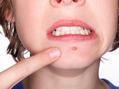 臉上長痘痘是體內(nèi)有毒素嗎 臉上長痘痘可以用酒精嗎 臉上長痘痘是體內(nèi)有毒素嗎 臉上長痘痘可以用酒精嗎