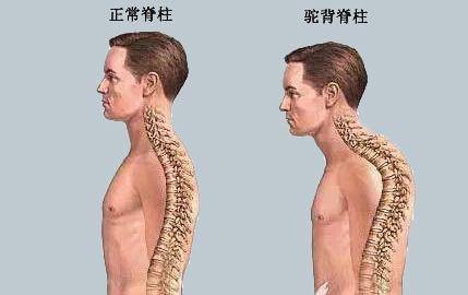 練胸肌會(huì)駝背嗎 如何避免產(chǎn)生駝背 練胸肌會(huì)駝背嗎 如何避免產(chǎn)生駝背