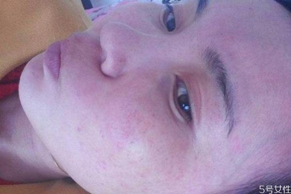 孩子過敏的癥狀有哪些 孩子過敏的原因