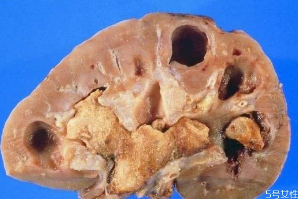 腎結(jié)石嚴重嗎 腎結(jié)石多大需要碎石 腎結(jié)石嚴重嗎 腎結(jié)石多大需要碎石