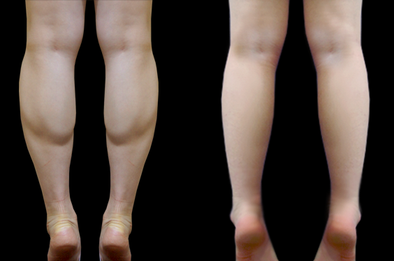 小腿腓腸肌怎么捏變瘦 拍打小腿腓腸肌能變瘦嗎 小腿腓腸肌怎么捏變瘦 拍打小腿腓腸肌能變瘦嗎