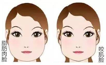 嬰兒肥會(huì)自己瘦嗎 咬肌肥大是天生的嗎