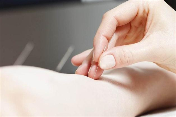 經(jīng)期可以針灸減肥嗎 針灸減肥會導致月經(jīng)推遲嗎