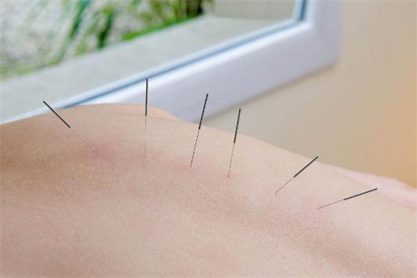 針灸減肥后可以吃飯嗎 針灸減肥后能吃東西嗎 針灸減肥后可以吃飯嗎 針灸減肥后能吃東西嗎