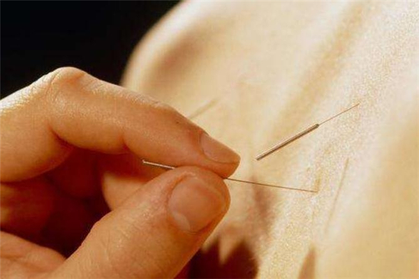 針灸減肥安全嗎 針灸減肥會(huì)影響生育嗎 針灸減肥安全嗎 針灸減肥會(huì)影響生育嗎