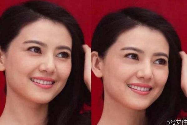 如何去除法令紋 去除法令紋的方法 如何去除法令紋 去除法令紋的方法