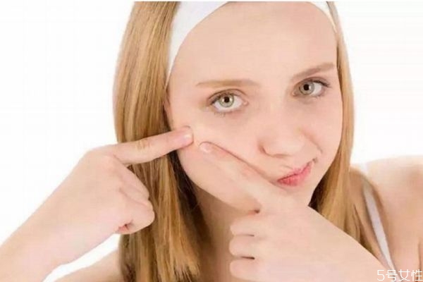 去痘痘可以用手?jǐn)D嗎 手可以擠痘痘嗎 去痘痘可以用手?jǐn)D嗎 手可以擠痘痘嗎