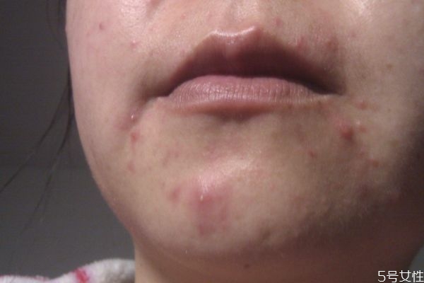 下巴有粉刺怎么去掉 去除下巴粉刺的方法 下巴有粉刺怎么去掉 去除下巴粉刺的方法