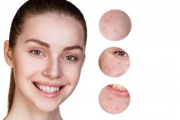 下巴有粉刺怎么去掉 去除下巴粉刺的方法 下巴有粉刺怎么去掉 去除下巴粉刺的方法